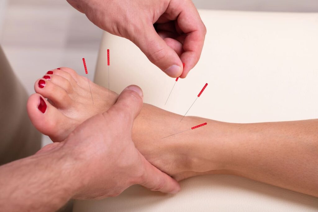 acupuncture for foot