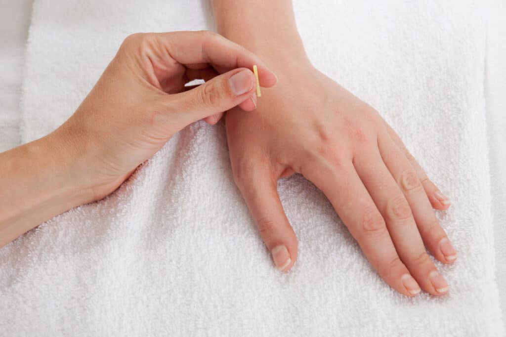 acupuncture for hands