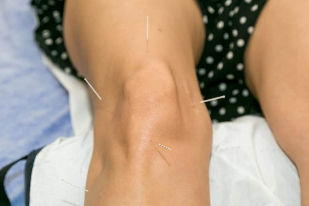 acupuncture for knee pain