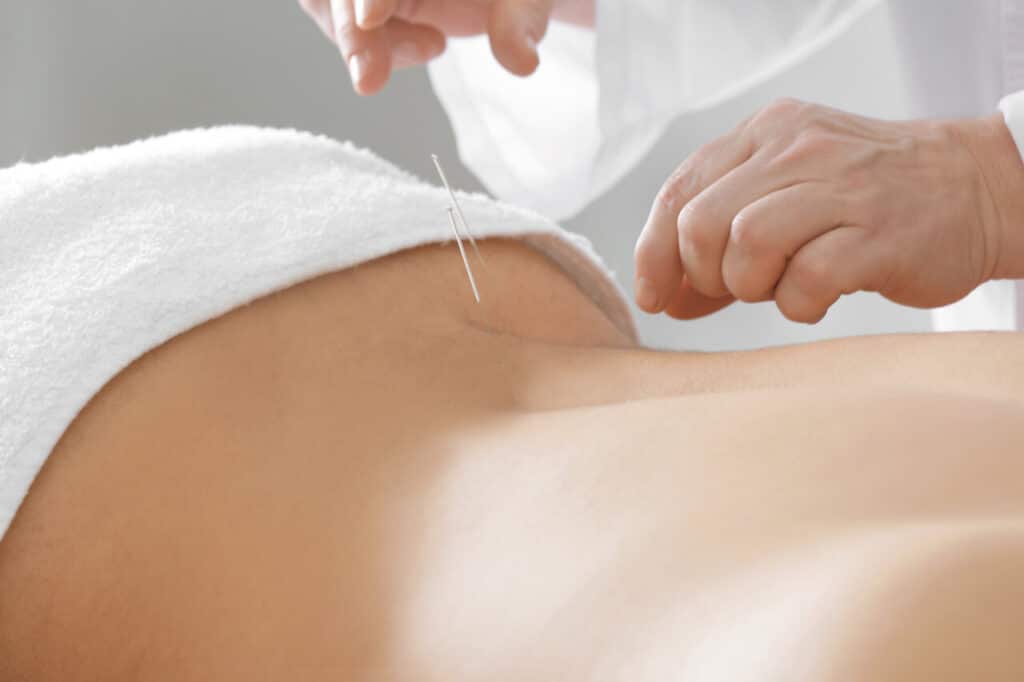 acupuncture for lower back pain