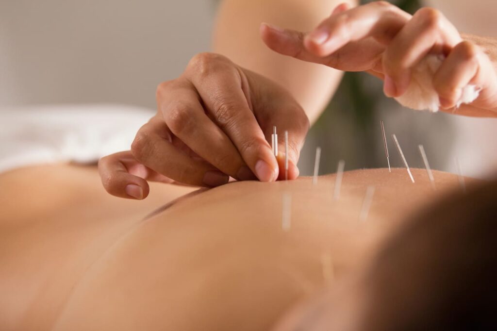 acupuncture for pain relief