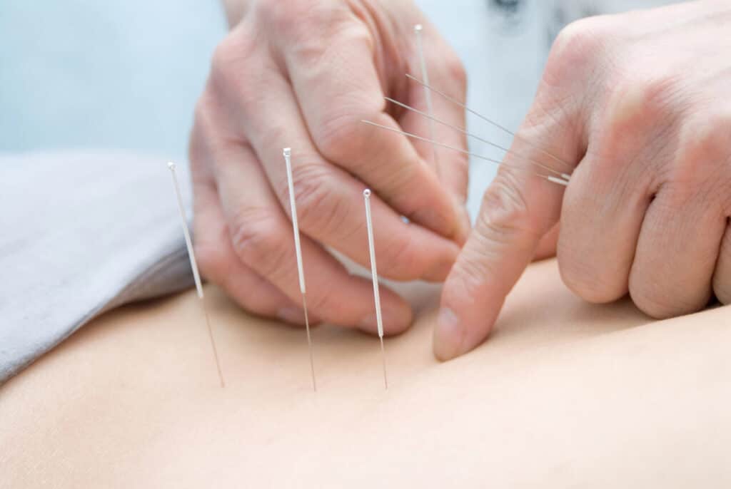 acupuncture for sciatica