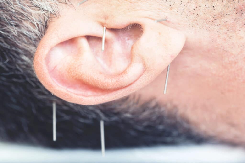 acupuncture for tinnitus