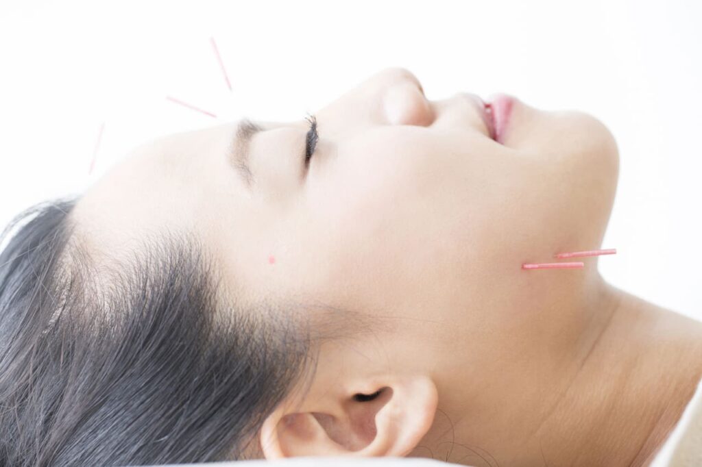 acupuncture for tmj