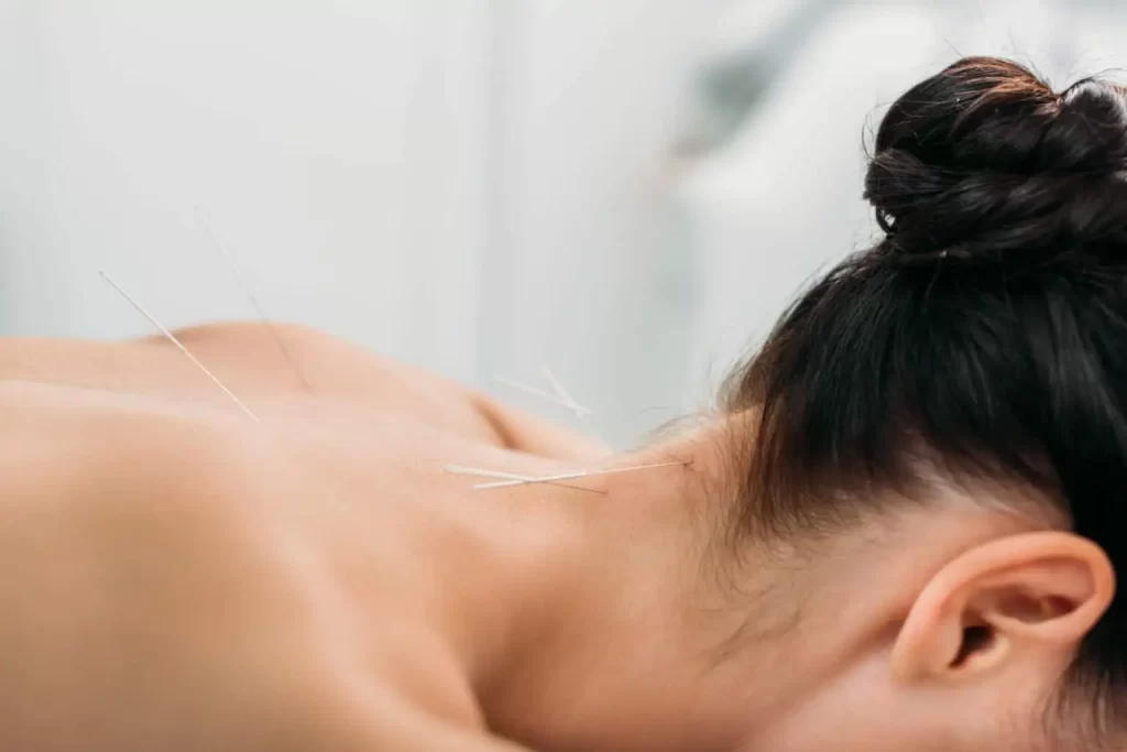 acupuncture scarborough
