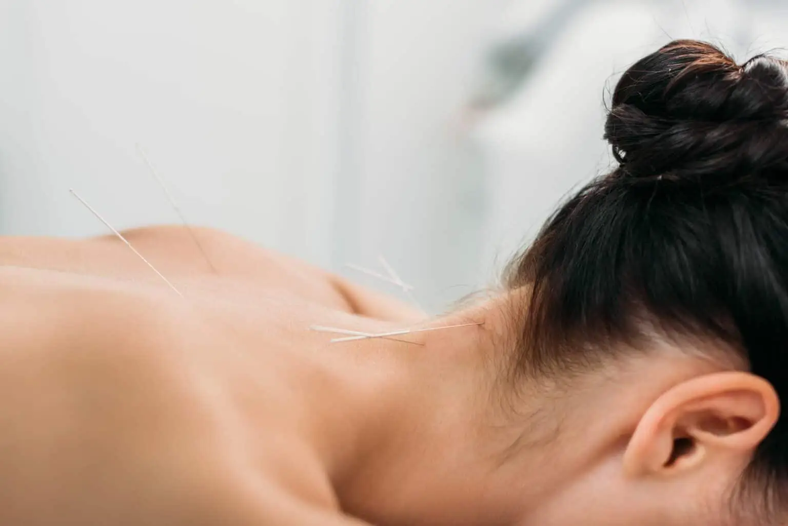 acupuncture scarborough