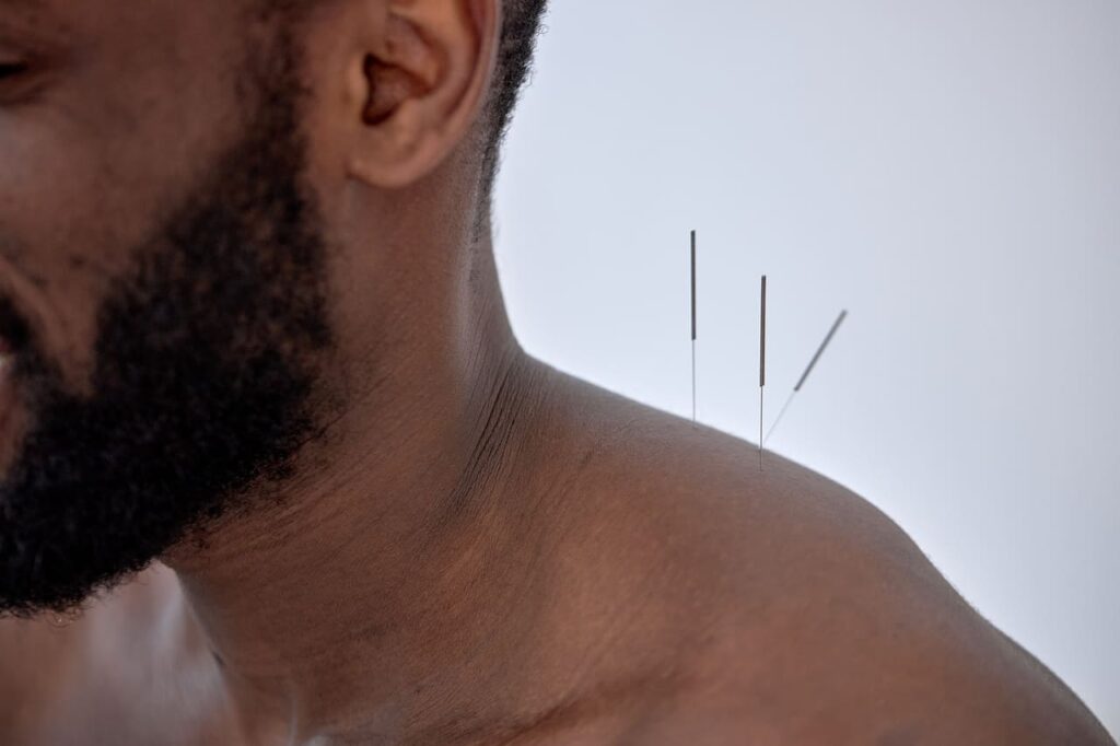can acupuncture help a trapped nerve