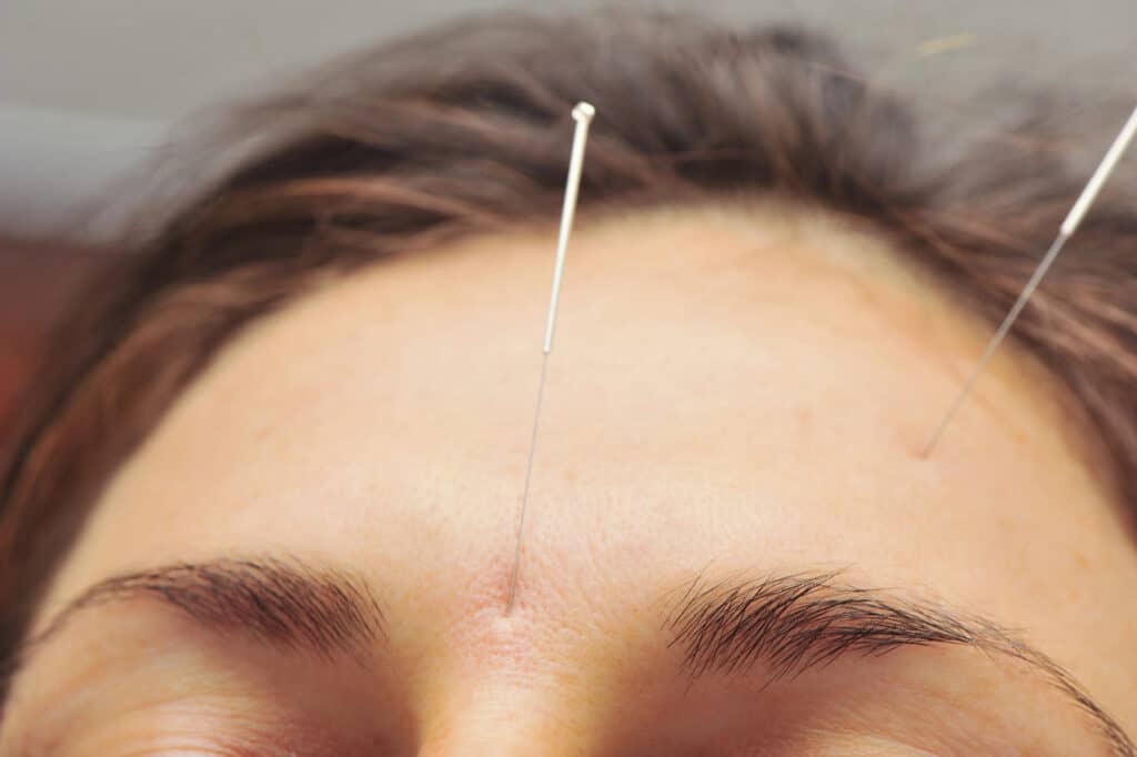 can acupuncture help vertigo