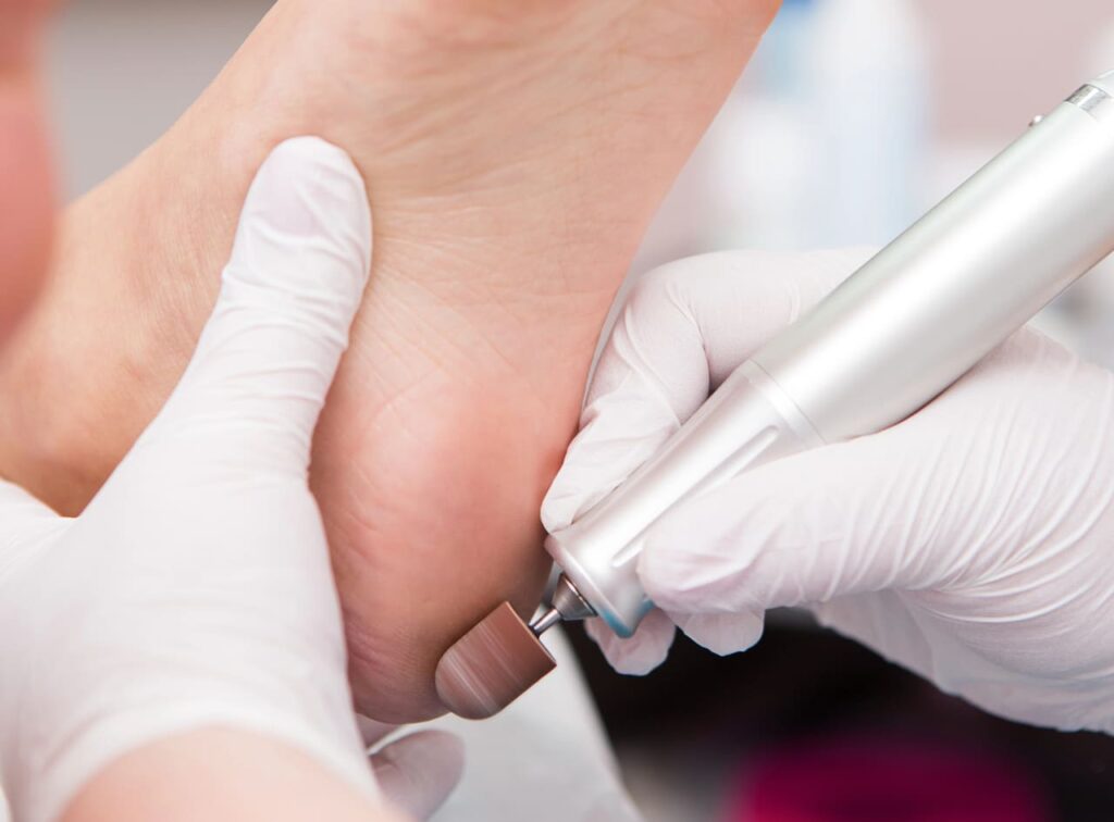 chiropody for heel pain