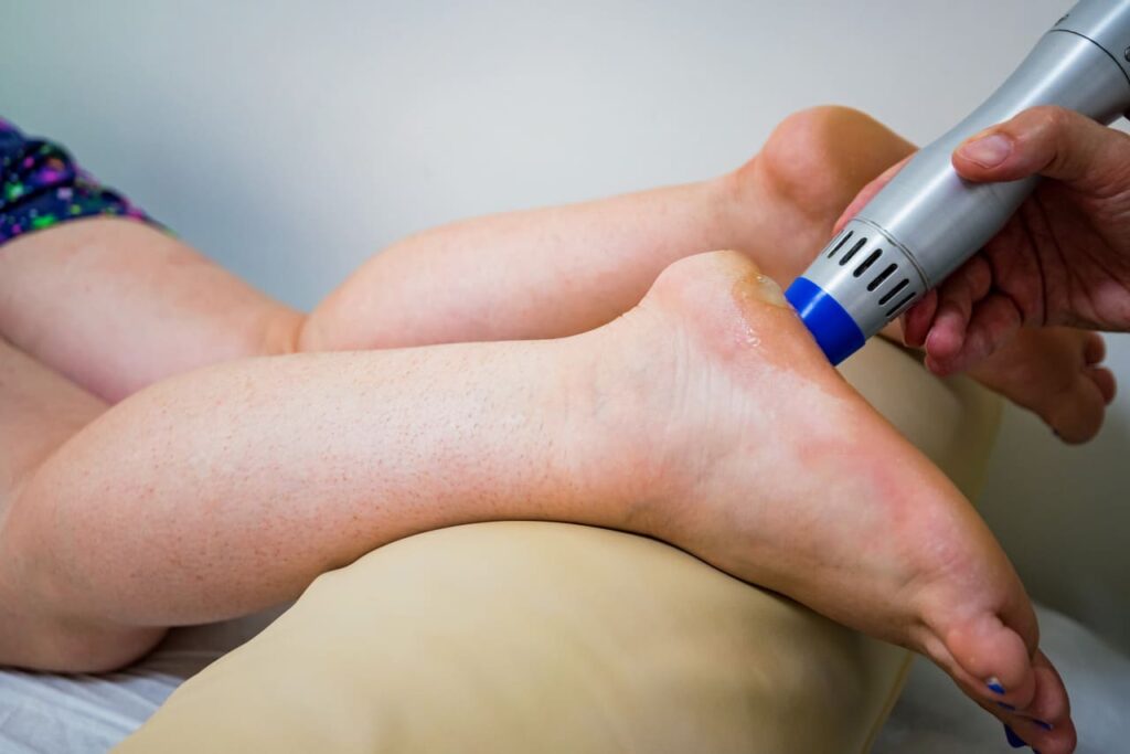 shockwave therapy for heel spurs